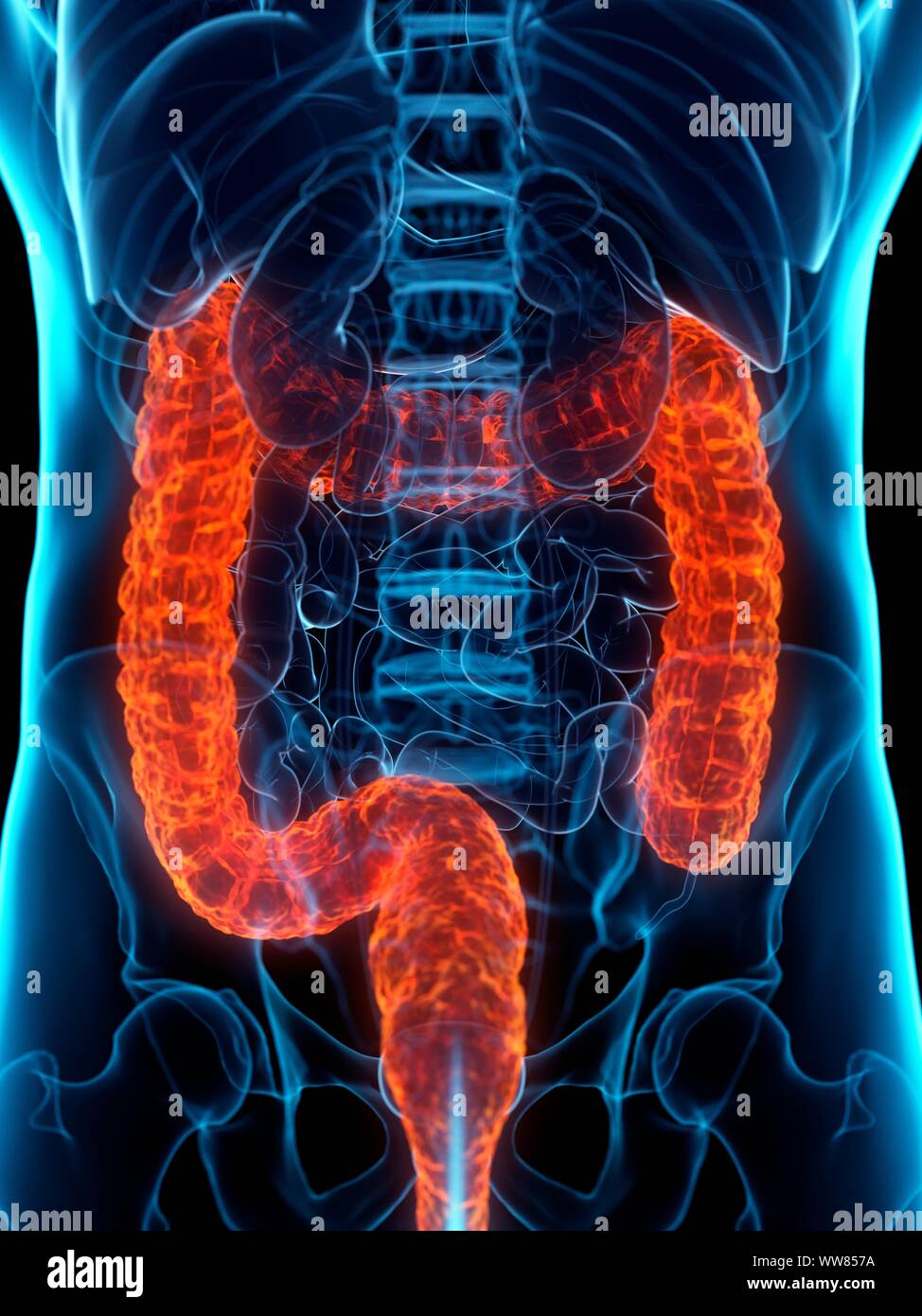 Damage Colon Diseased colon, conceptual illustration Stock Photo - Alamy