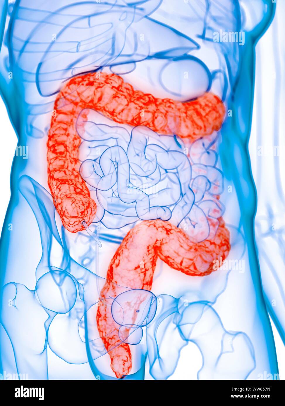 Damage Colon Diseased colon, conceptual illustration Stock Photo - Alamy