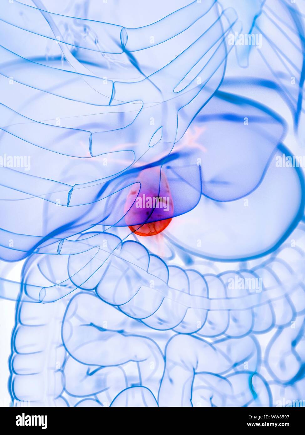 Diseased gallbladder, conceptual illustration Stock Photo