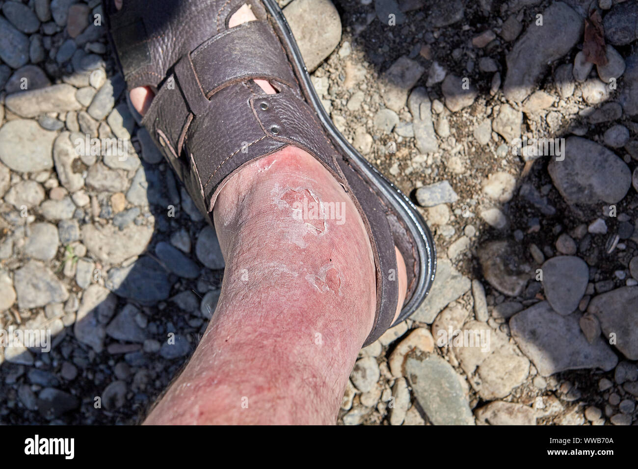 Skin burn on the foot, redness, peeling and skin irritation on the