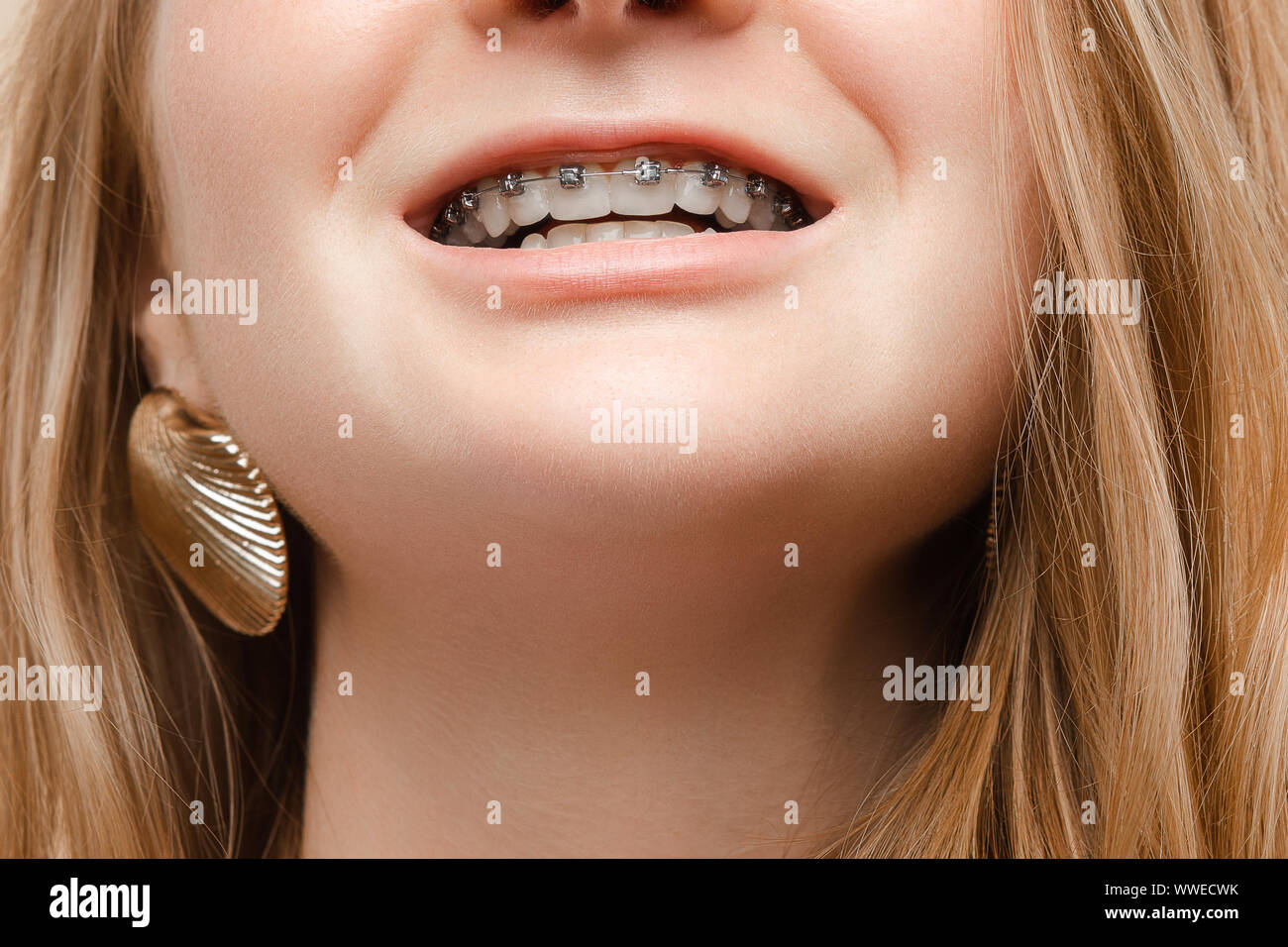 Extreme closeup teenager woman smiling with open mouth showing braces