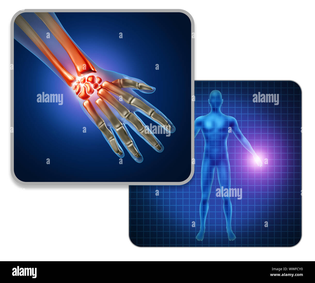 Human hand joint pain concept as skeleton and muscle anatomy of the body with a group of sore wrist and finger joints as a painful injury. Stock Photo