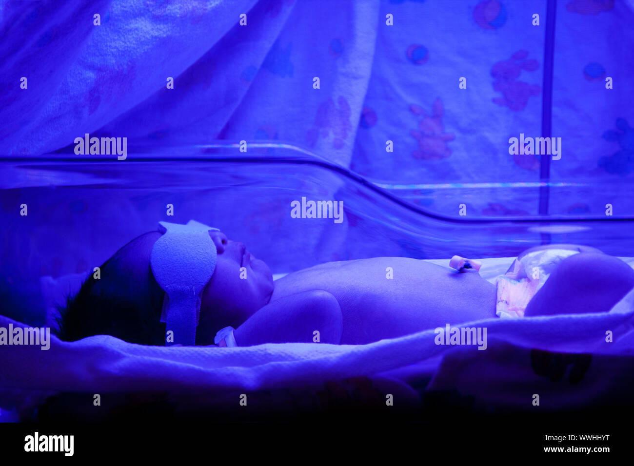 Newborn baby with neonatal jaundice and high bilirubin hyperbilirubinemia under blue UV light for phototheraphy. Stock Photo