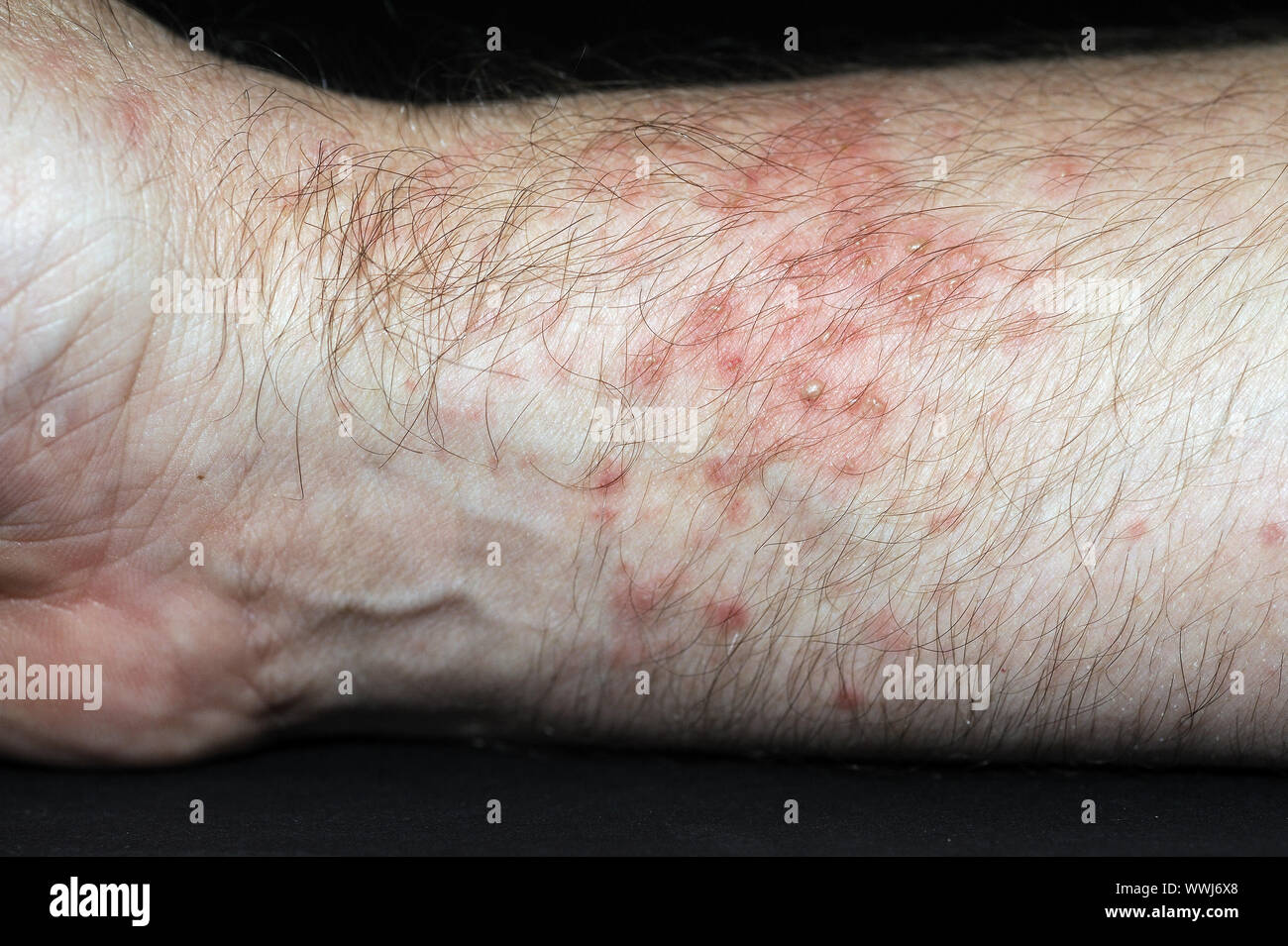 Strongly red, blistered skin after netting with sea anemones, Heteractis spec. Stock Photo