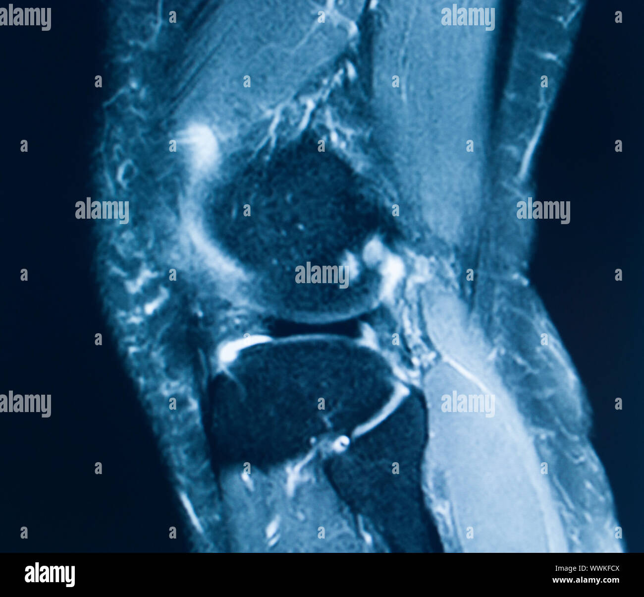 Knee sports injury mri mcl grade 2 tear resonance imaging