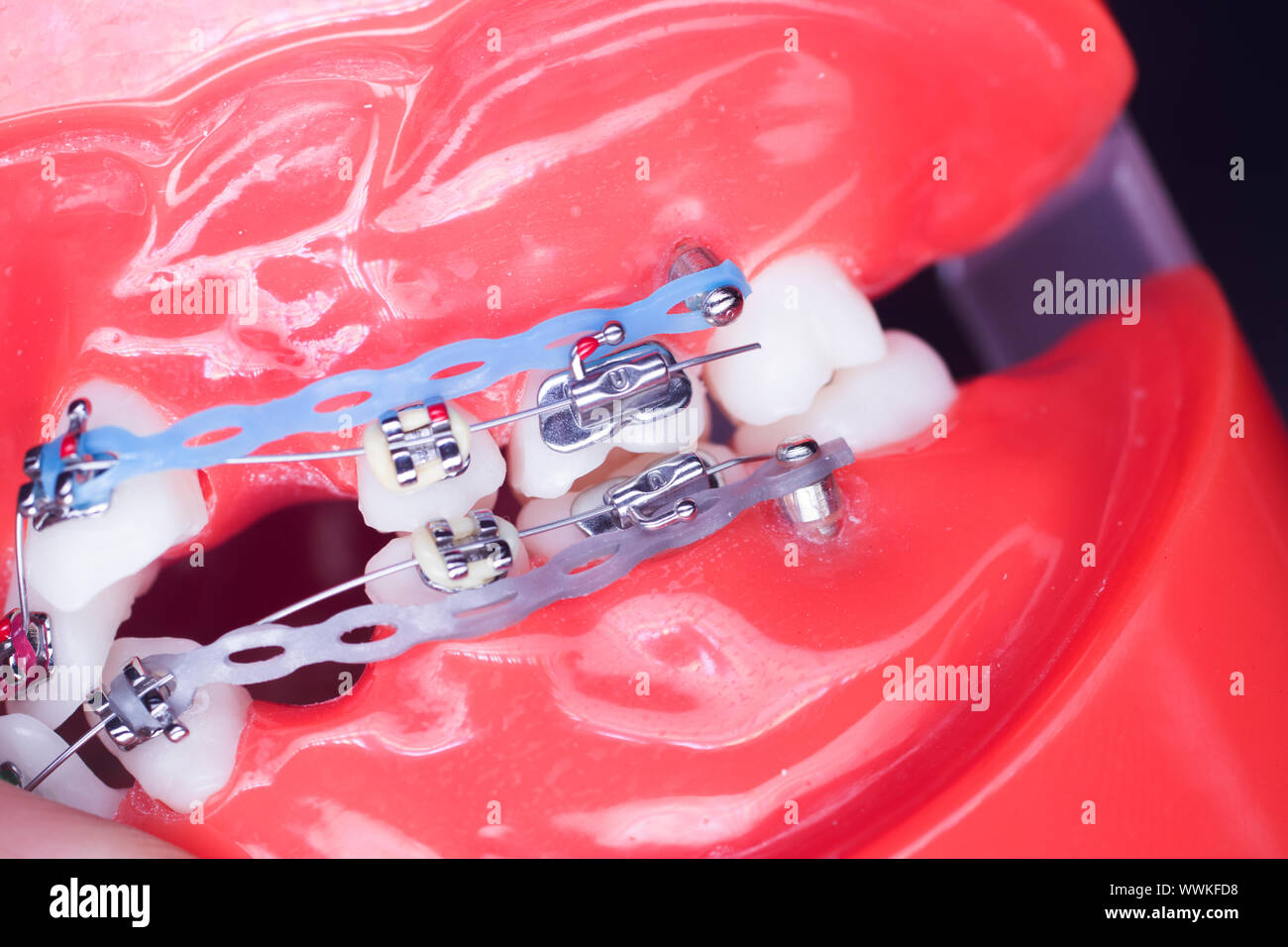 Modern metal retainers and plastic algners wire dental brackets teeth