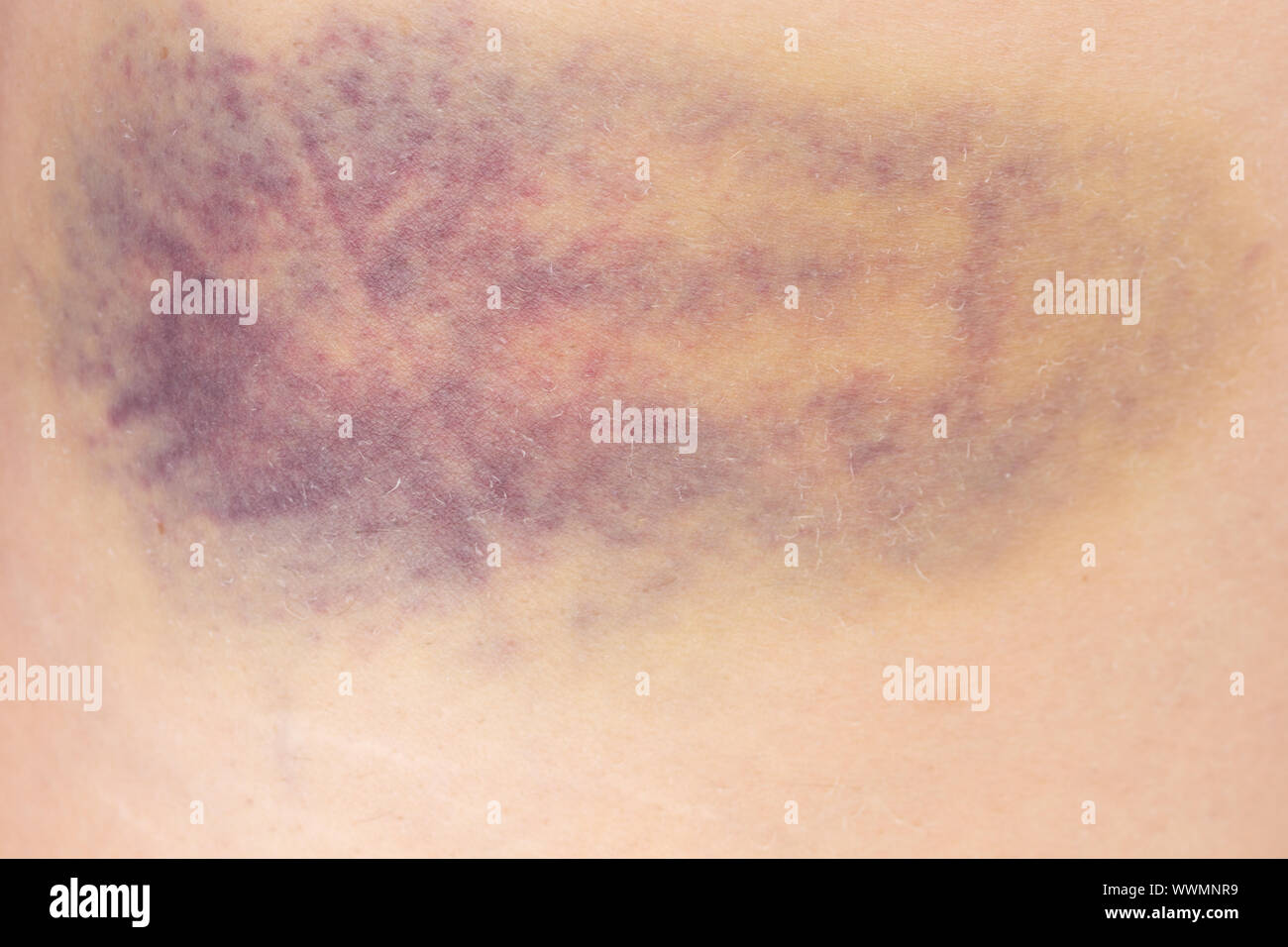Hematoma on a woman thigh after a bruise or contusion Stock Photo Alamy