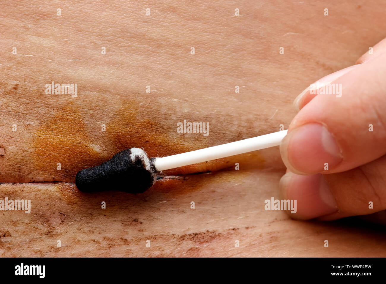 Use of 2024 tincture of iodine