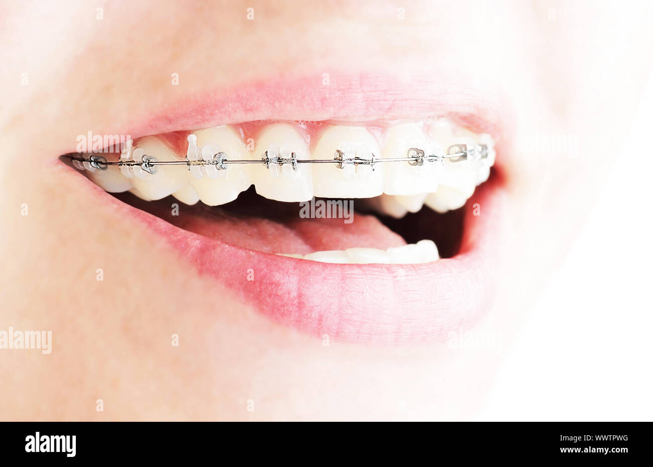 Teeth with braces Stock Photo - Alamy