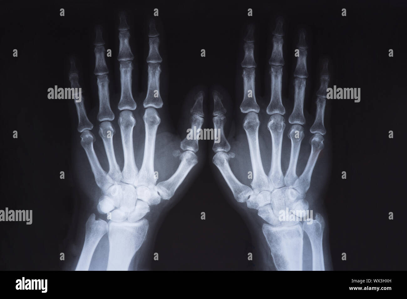 Medical x ray hands image Stock Photo