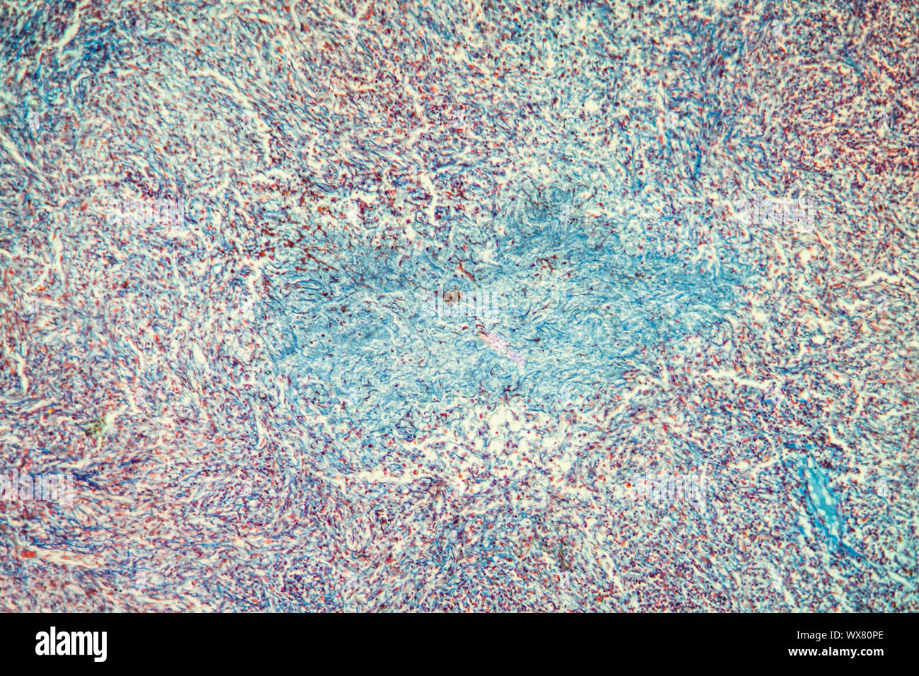 Gallbladder tumor tissue under the microscope 100x Stock Photo - Alamy