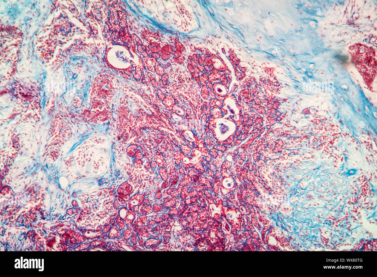 Mixed tumor of the parotid gland Diseased tissue 100x Stock Photo