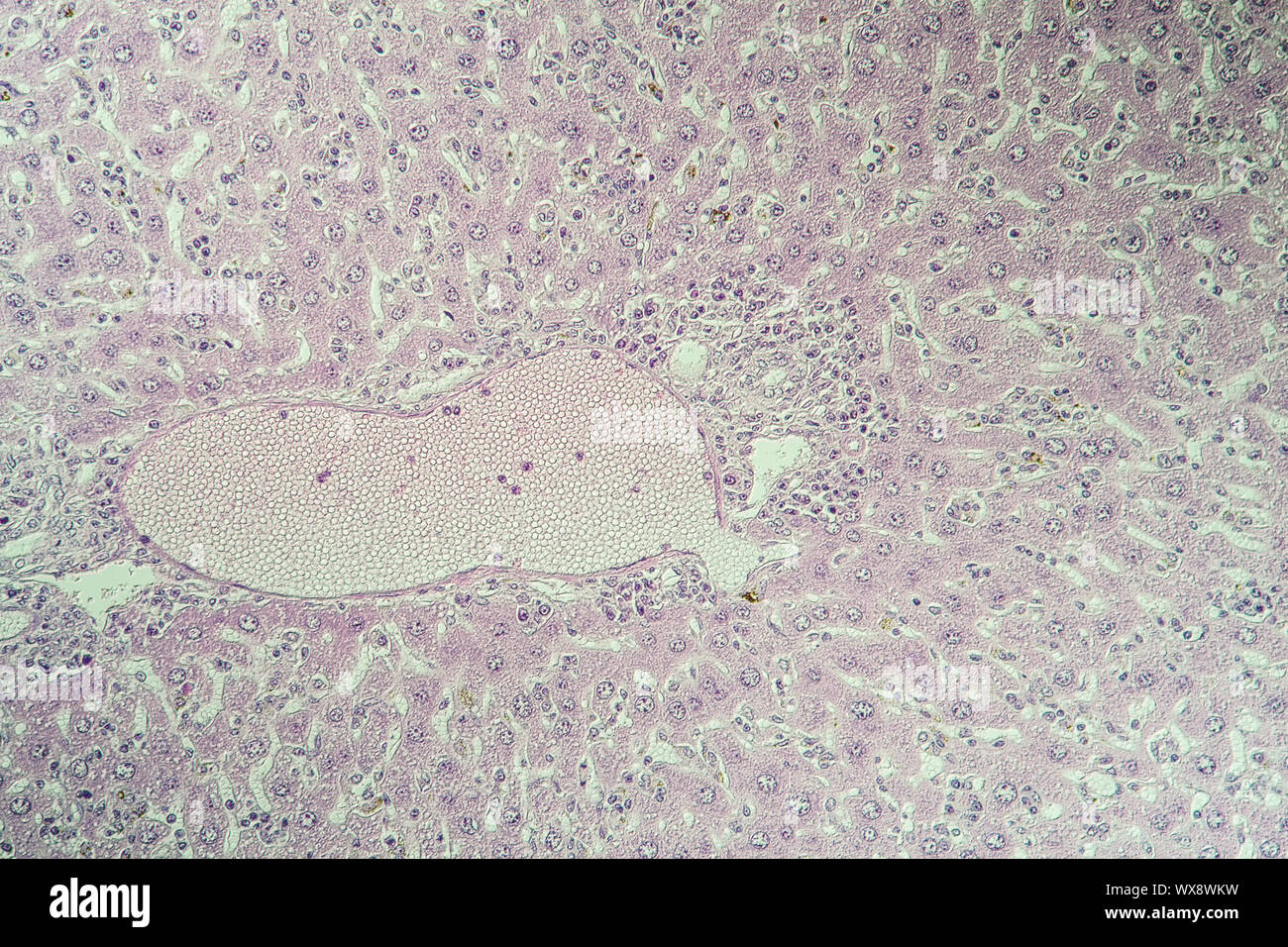 Liver mouse, schistosomiasis diseased tissue 100x Stock Photo