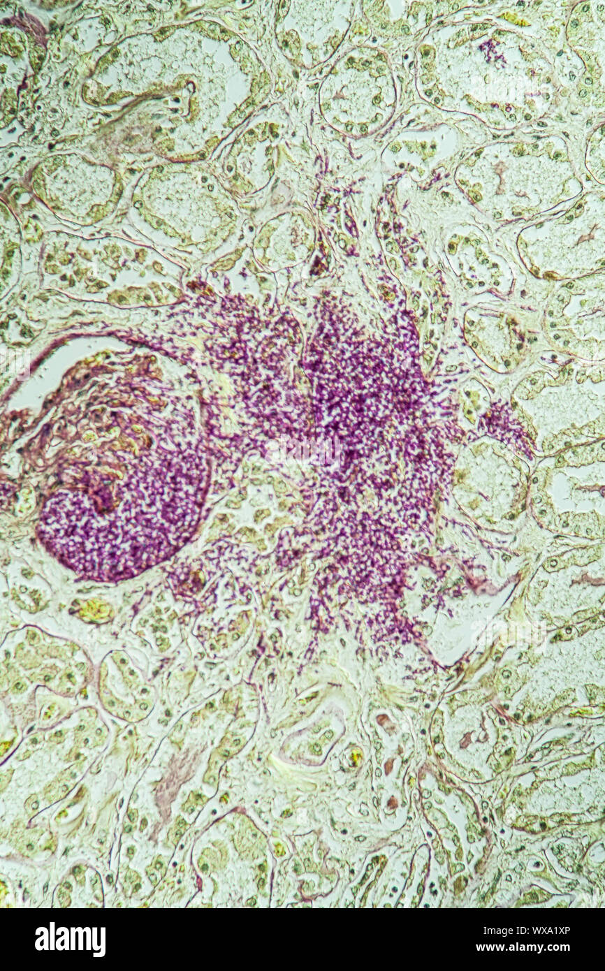 Kidney an AIDS patients tissue with the fungus Candida grow through