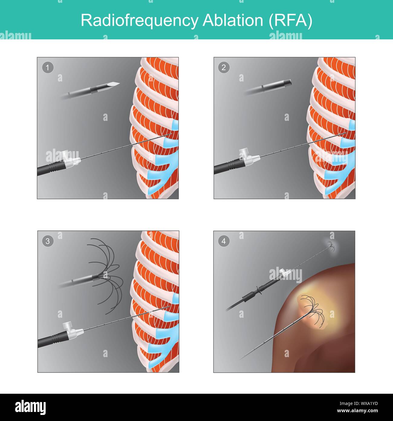 Sample illustrations for the treatment of tumour  in human organs  using high frequency radio waves through an electrode. The heat from high frequency Stock Vector