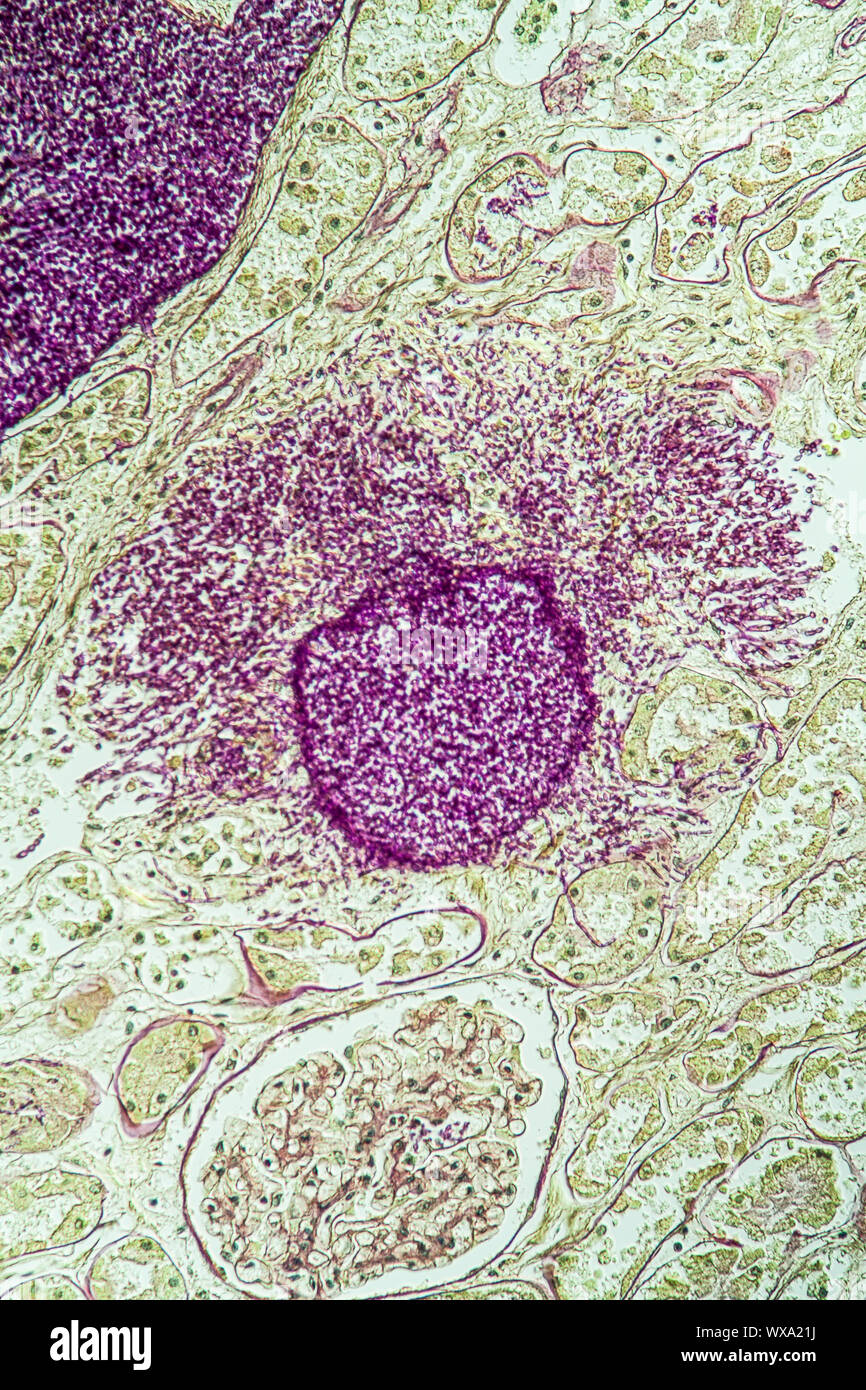 Kidney an AIDS patients tissue with the fungus Candida grow through