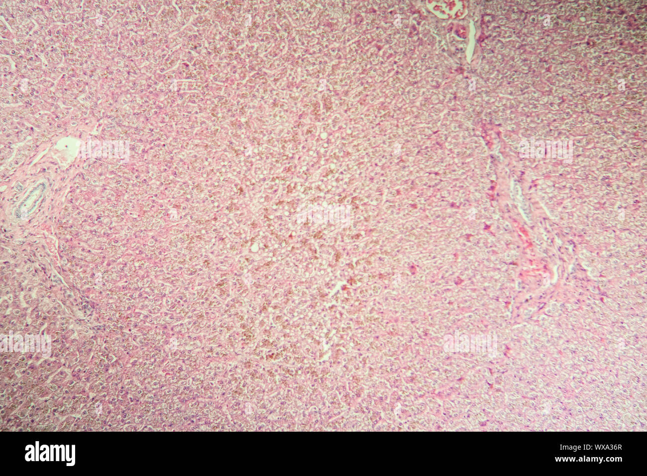 Dubin Johnson liver disease in the microscope 100x Stock Photo