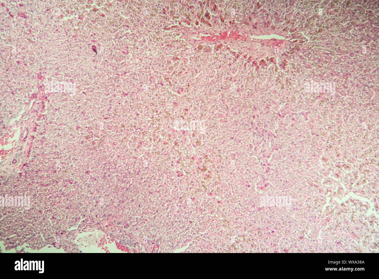 Dubin Johnson liver disease in the microscope 100x Stock Photo Alamy