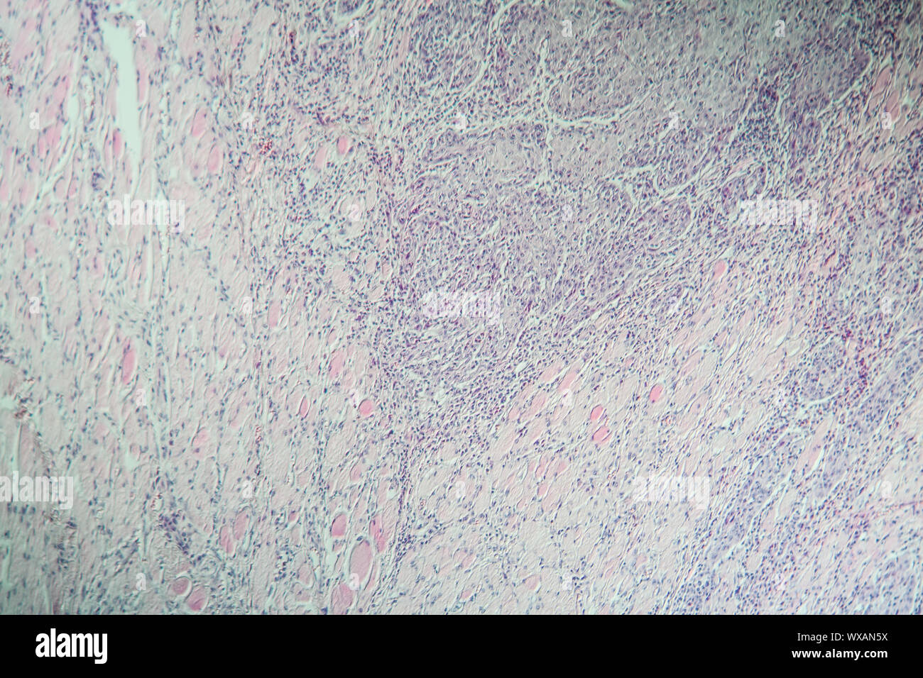 Lips carcinoma under the microscope 100x Stock Photo Alamy