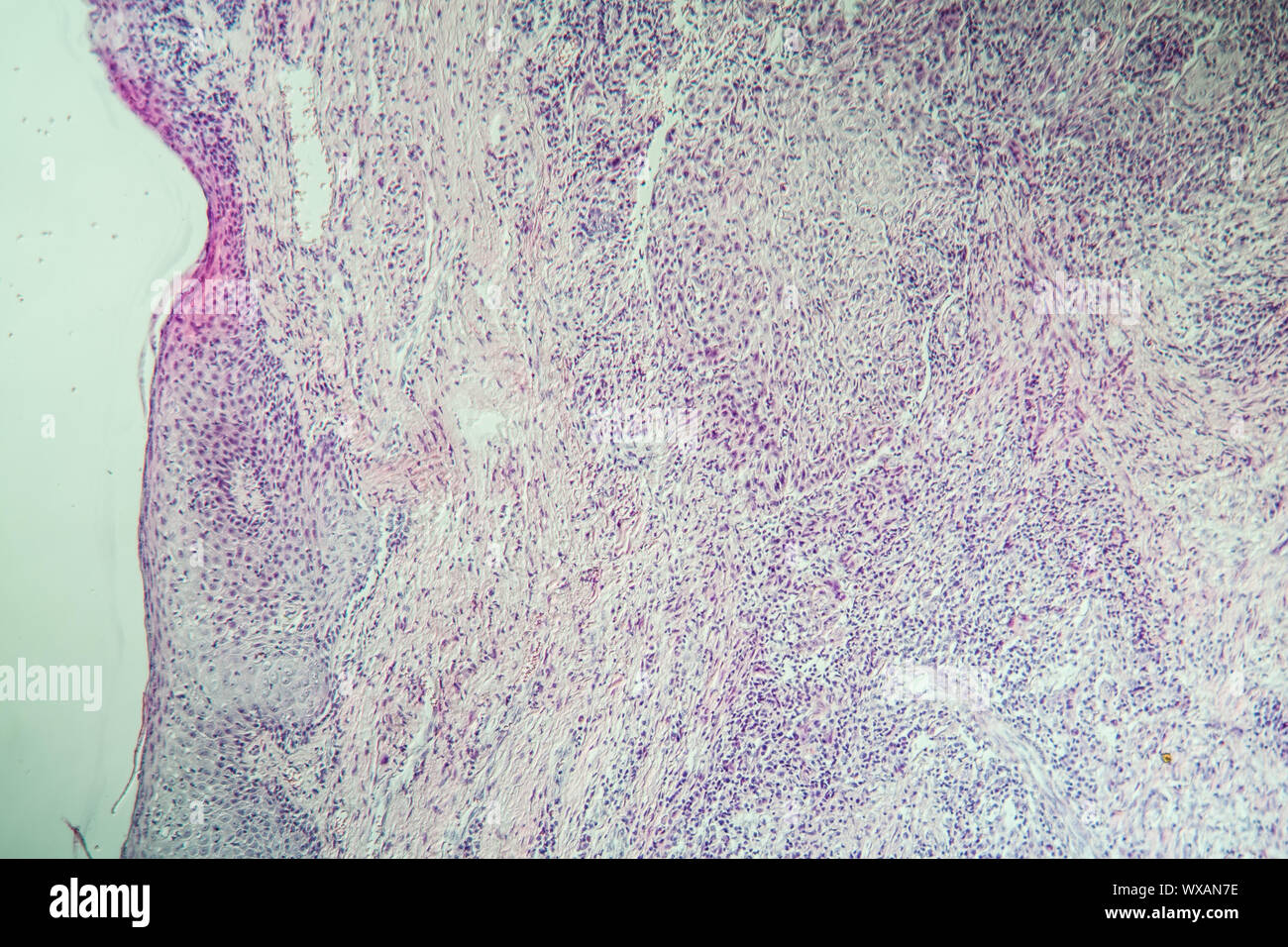 Lips carcinoma under the microscope 100x Stock Photo Alamy