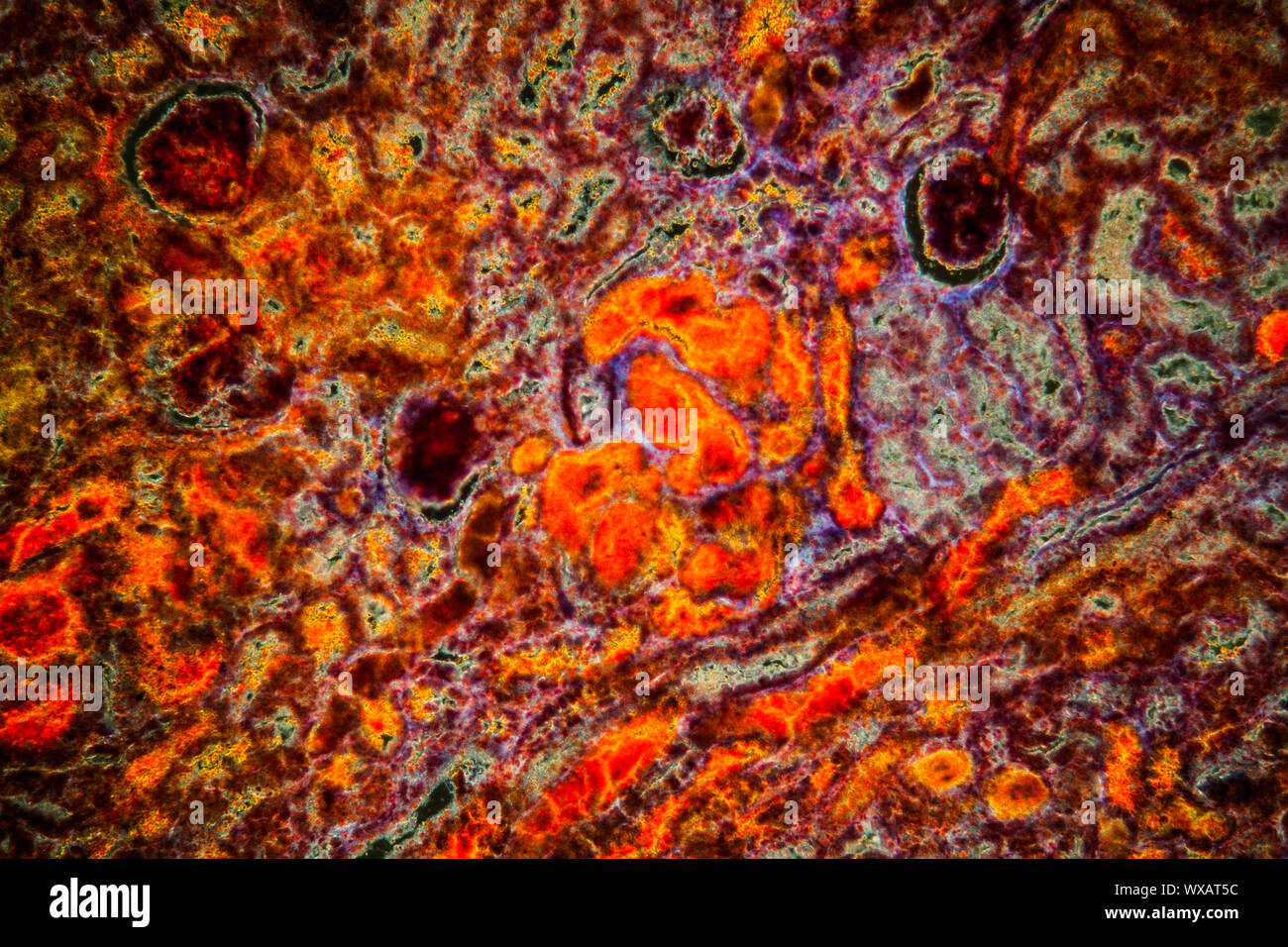 Kidney bleeding diseased tissue under the microscope 100x Stock Photo