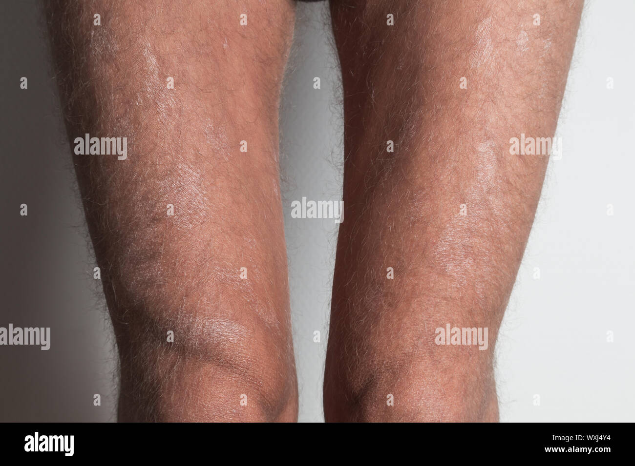 Large plaque parapsoriasis on caucasian man legs Stock Photo Alamy