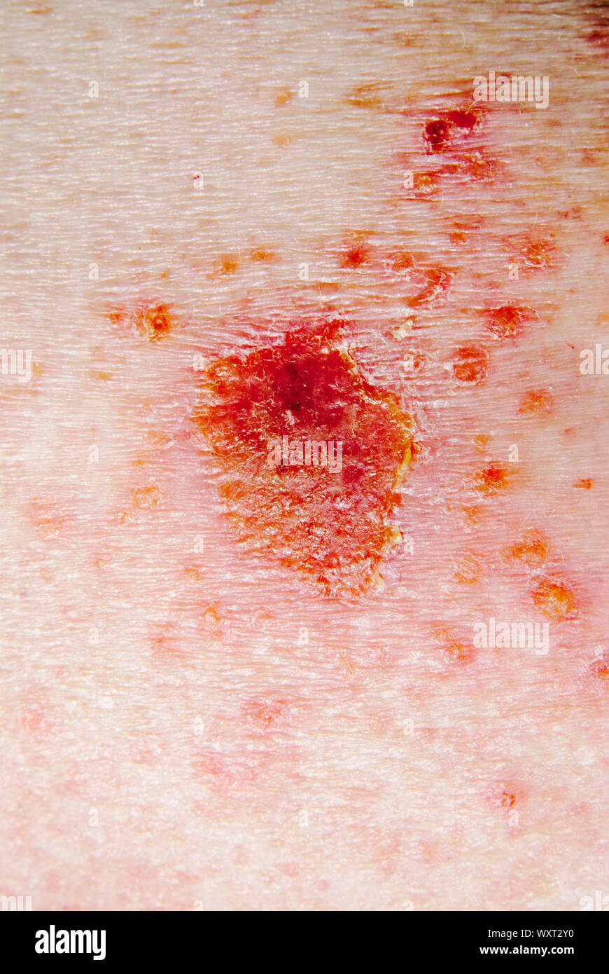 basal cell carcinoma skin cancer being treated with 5 percent