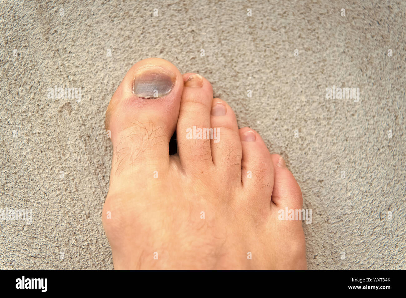 Injury of toe nail. Effects wearing footwear. Nail