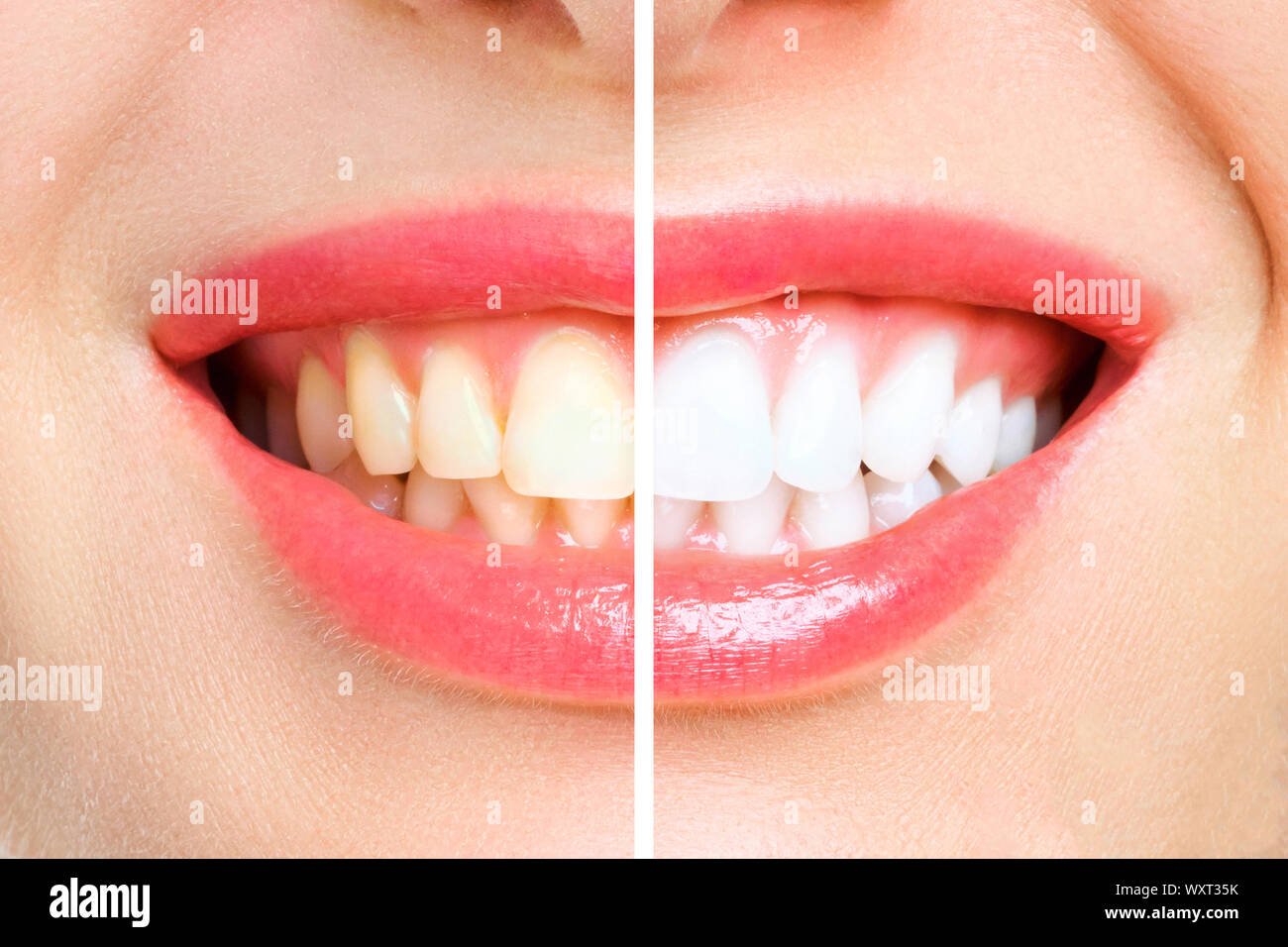 woman teeth before and after whitening. Over white background Stock Photo