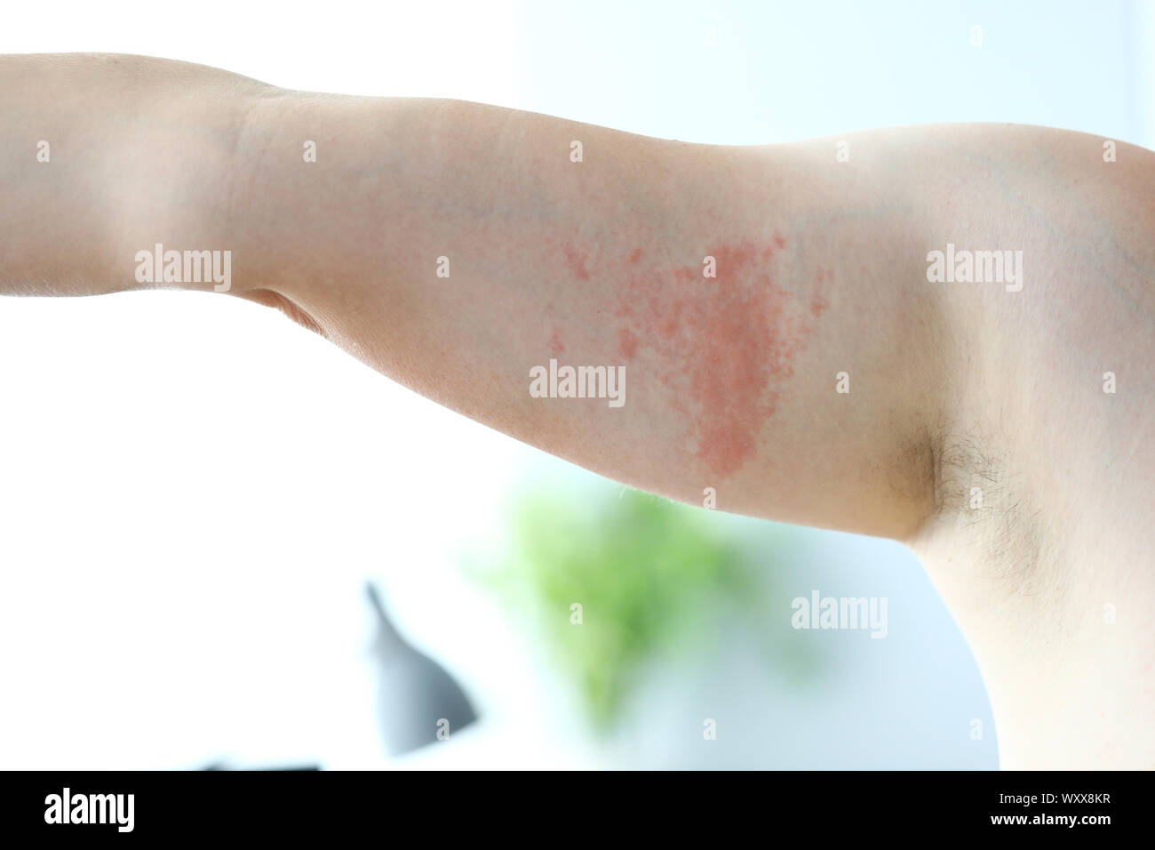 Hives Body High Resolution Stock Photography And Images Alamy