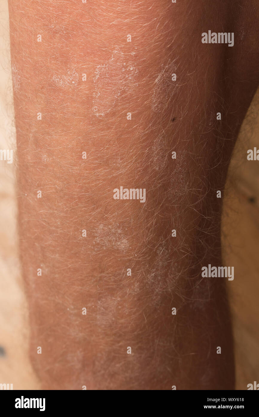 Large plaque parapsoriasis on caucasian man legs Stock Photo Alamy
