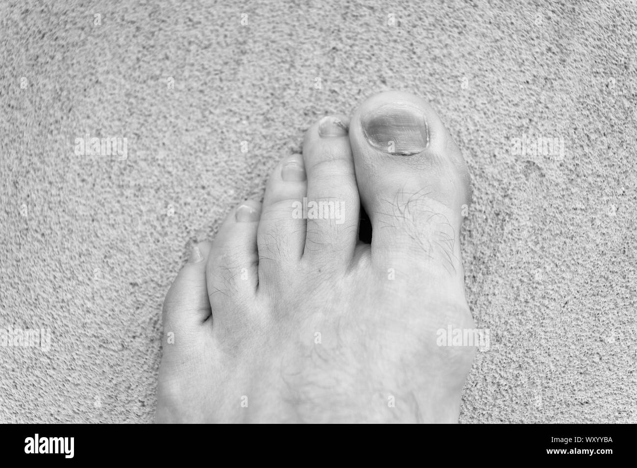 Fungal infection body Black and White Stock Photos & Images Alamy