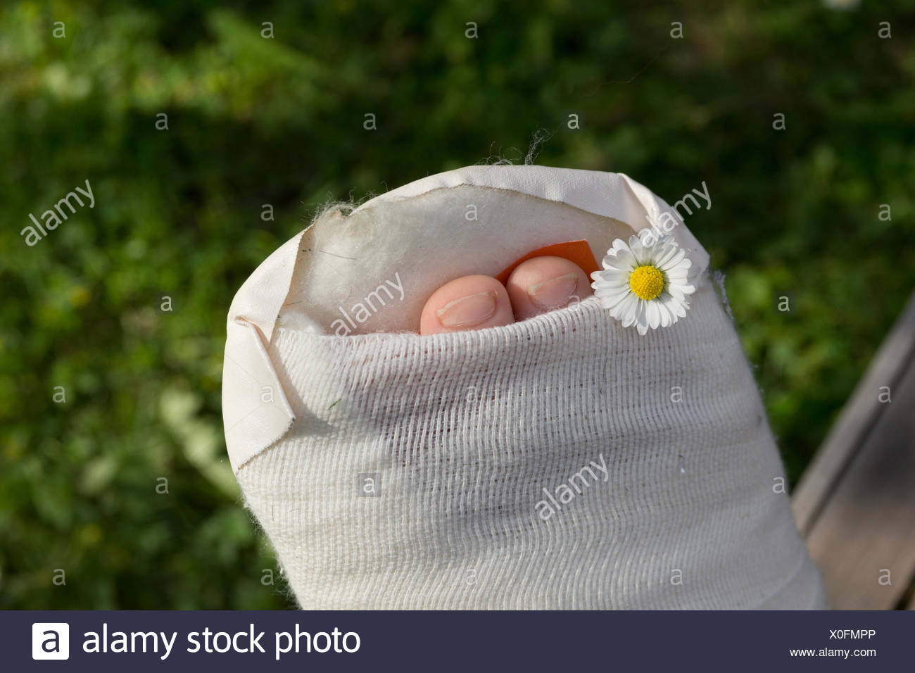 Gipsfuß eines Kindes Stock Photo