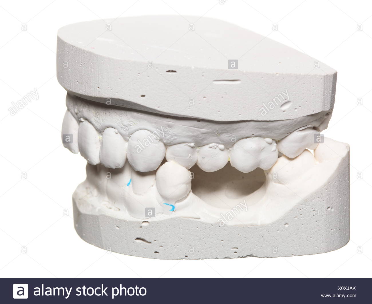 Dental gypsum model  mould of teeth in plaster Stock Photo 