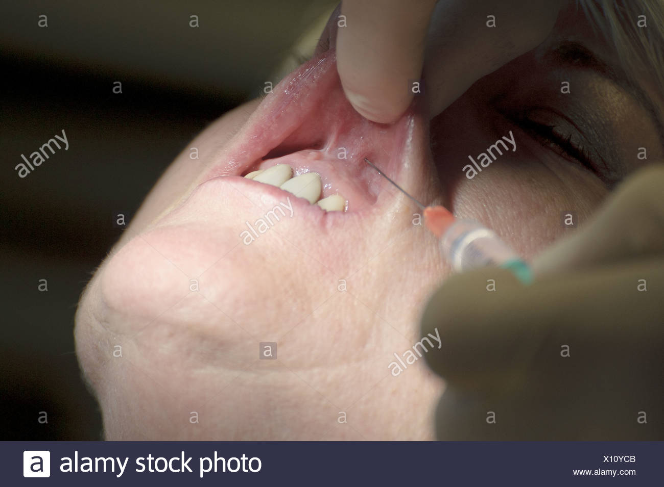 Infiltration anesthesia in dentistry 34 Infiltration anesthesia in dentistry 55