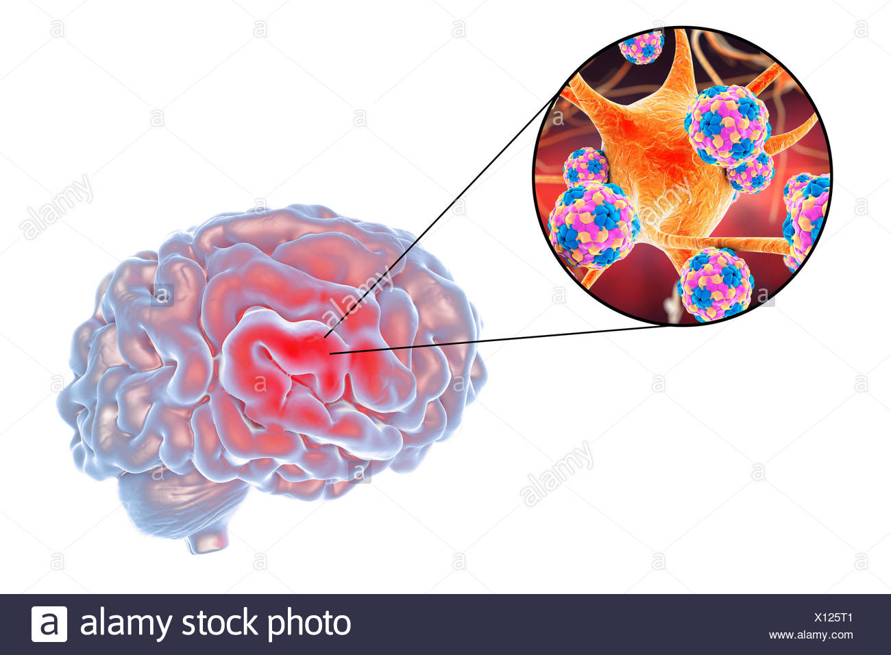 Viral Encephalitis Conceptual Illustration Showing Brain And Close Up View Of Viruses Infecting Neurons Stock Photo Alamy