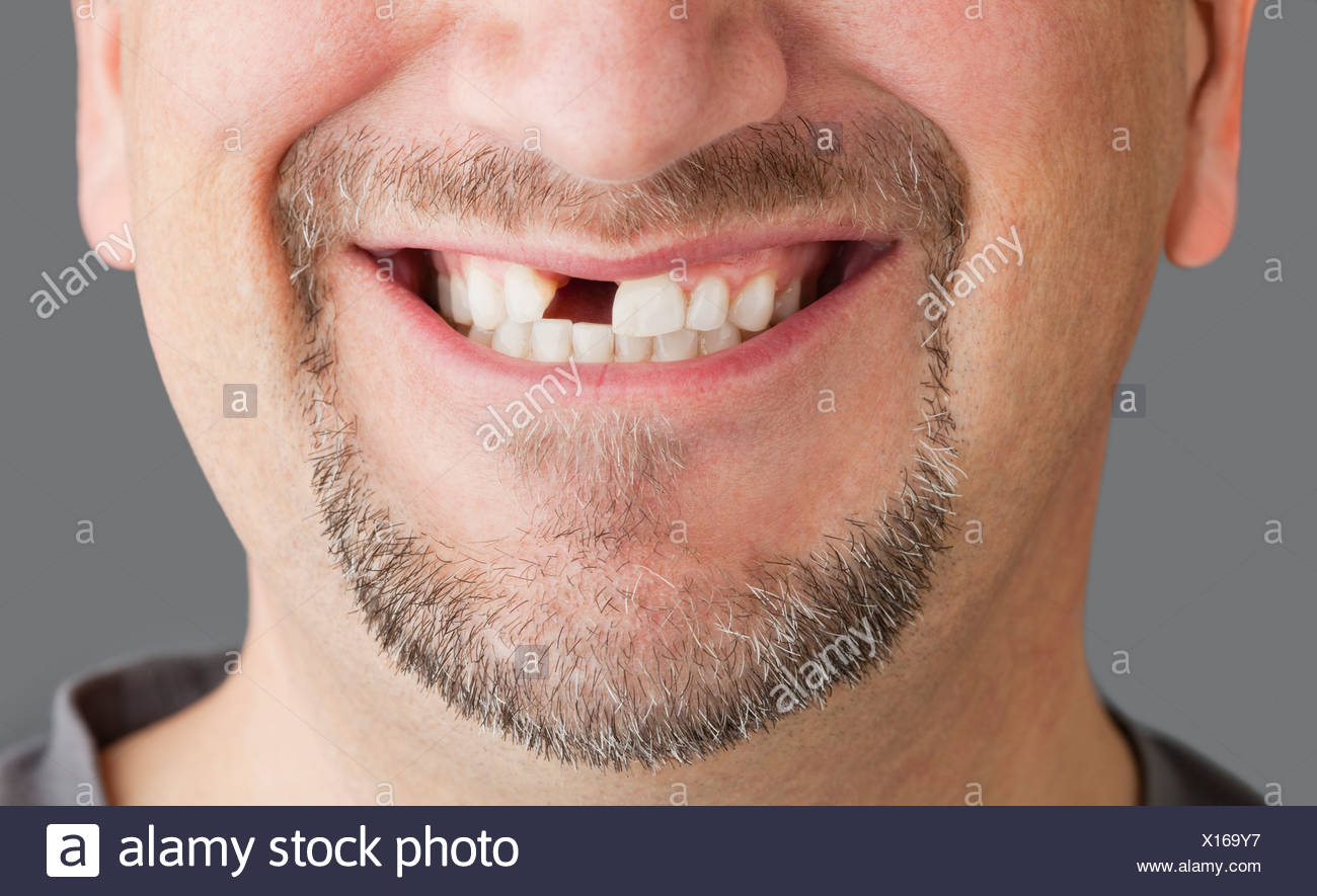 Missing Teeth Adult High Resolution Stock Photography and Images Alamy