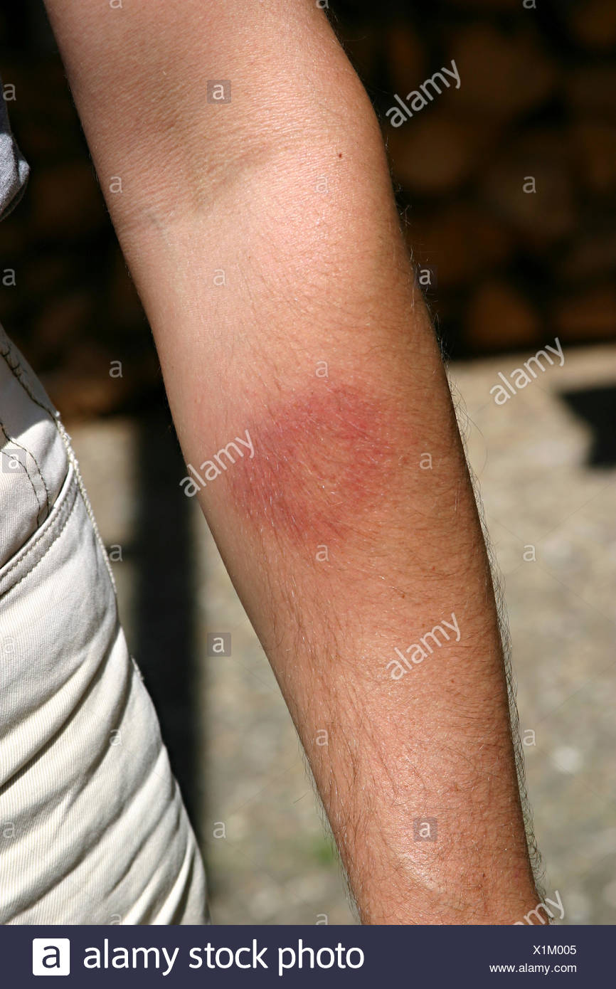 Zeckenbiss Stock Photo Alamy