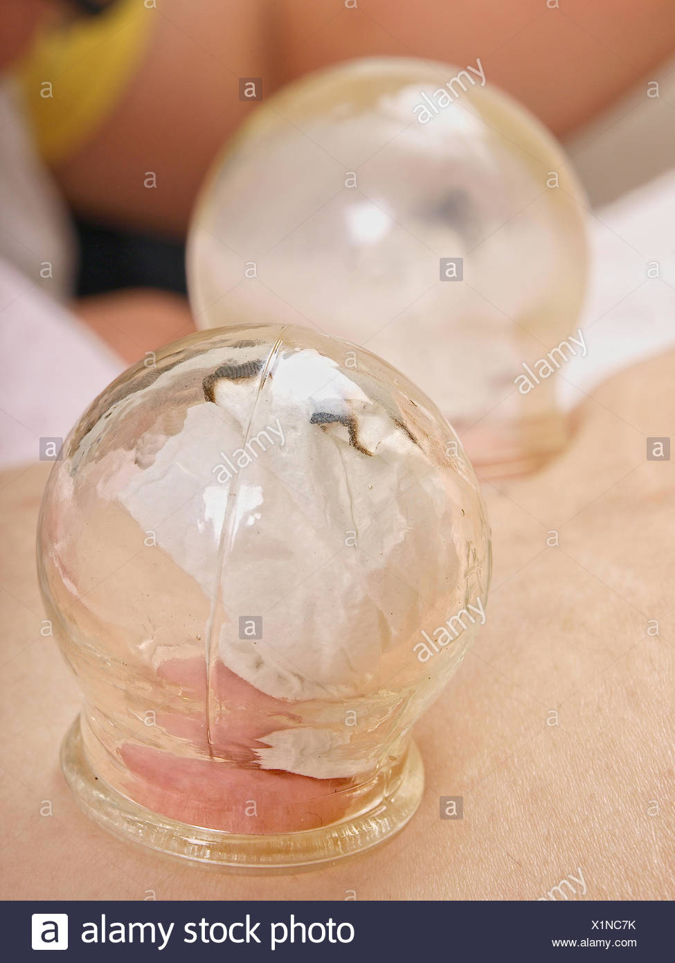 Cupping Massage Stock Photos & Cupping Massage Stock Images Alamy