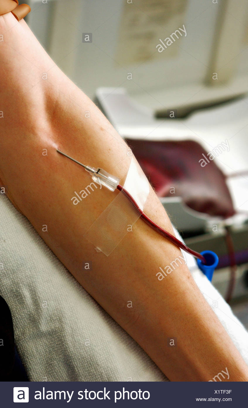 Hemochromatosis Stock Photos & Hemochromatosis Stock Images - Alamy