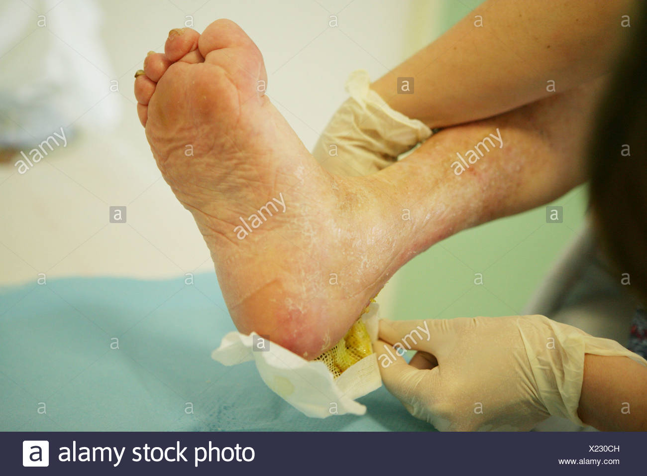 Bedsores Stock Photos & Bedsores Stock Images Alamy