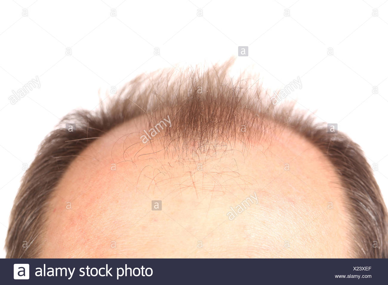 Male Pattern Baldness Stock Photos & Male Pattern Baldness Stock Images ...