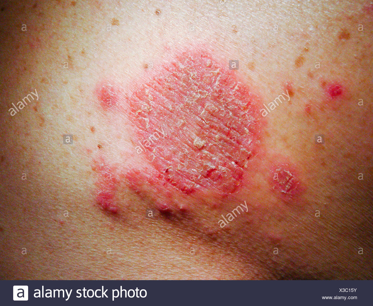 Discoid Eczema High Resolution Stock Photography and Images Alamy