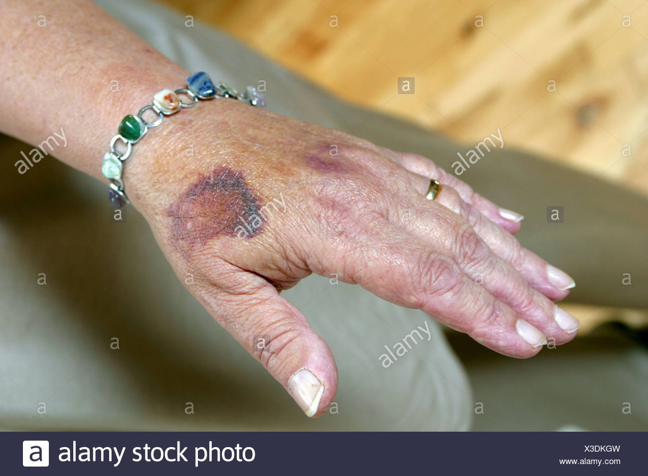 Unexplained Bruises