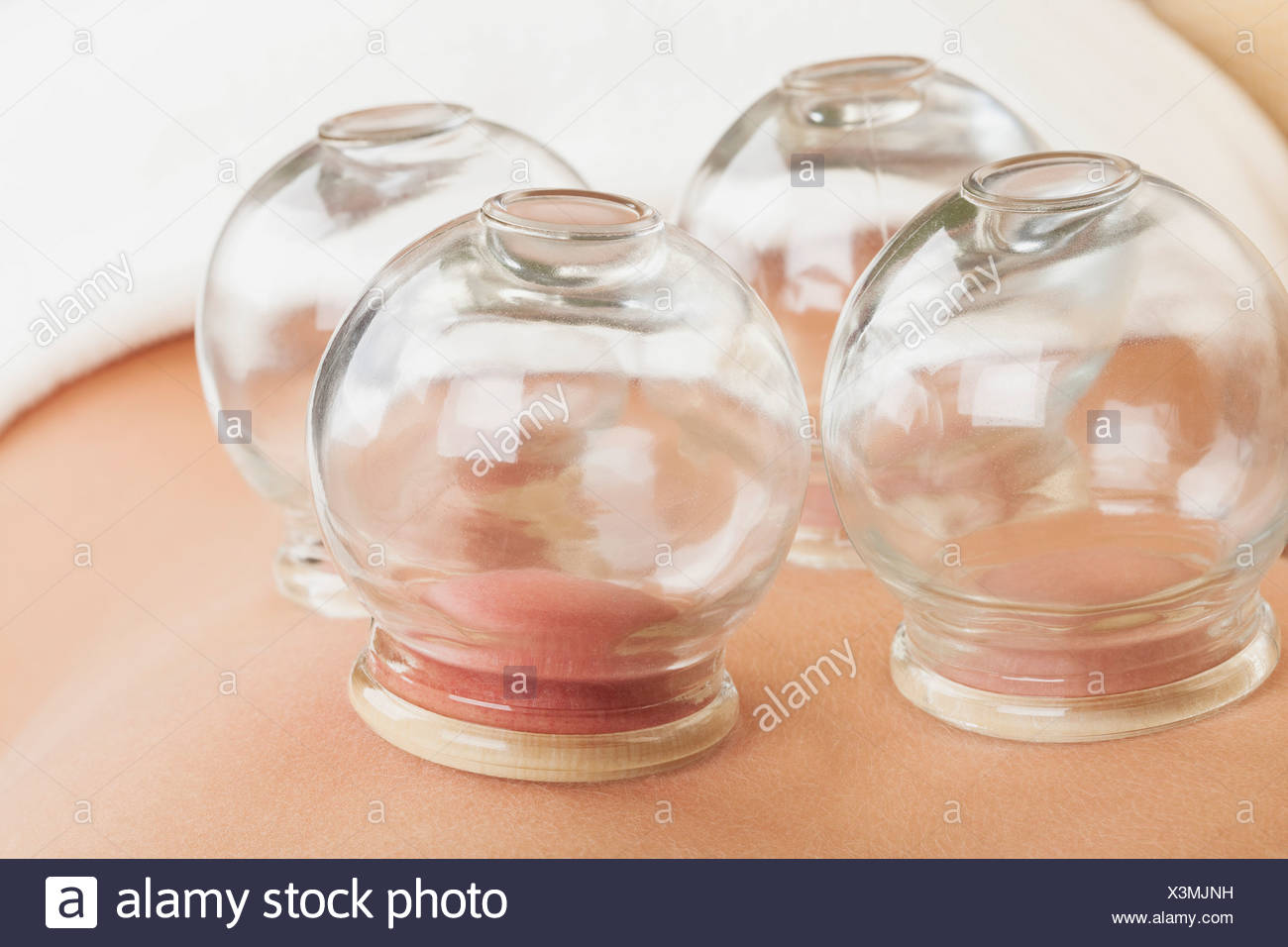 Cupping Chinese Treatment Stock Photos & Cupping Chinese Treatment