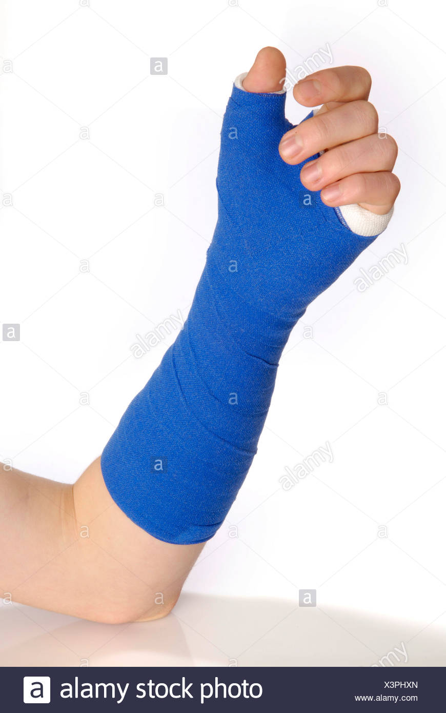 Her Fractured Wrist Cast