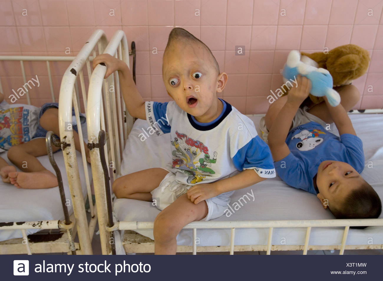 Agent Orange Victim Stock Photo Alamy