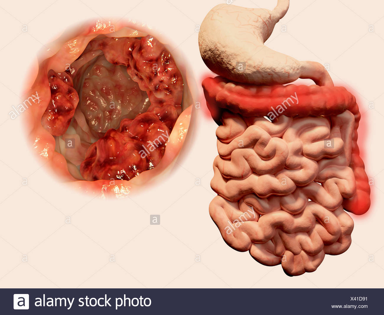 What Is Malignant Neoplasm Of Colon at Alexis Hoff blog