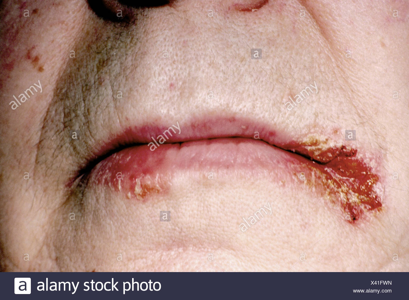 Perleche Stock Photo Alamy