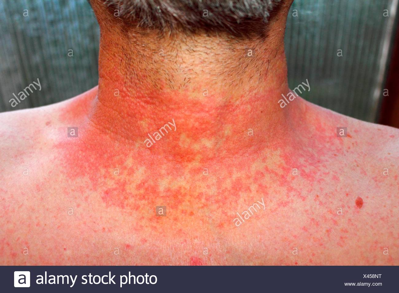 Dermatitis Rash On Chest